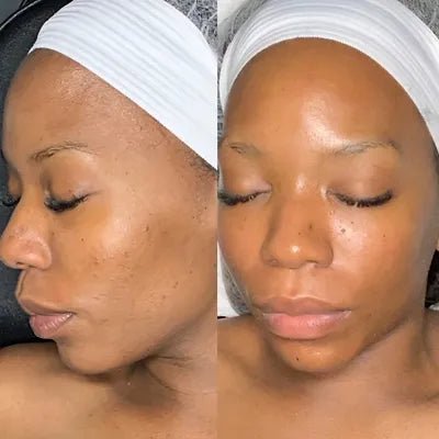 Microdermabrasion Facial | Seraphim Beauty